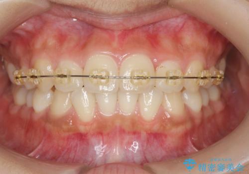 前歯のねじれ、すれ違いを改善　部分ワイヤー+マウスピース矯正の治療中