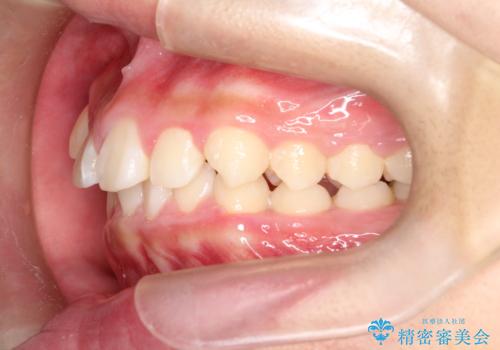 八重歯・歯並びのデコボコとディープバイトを改善した抜歯ワイヤー矯正症例の治療前