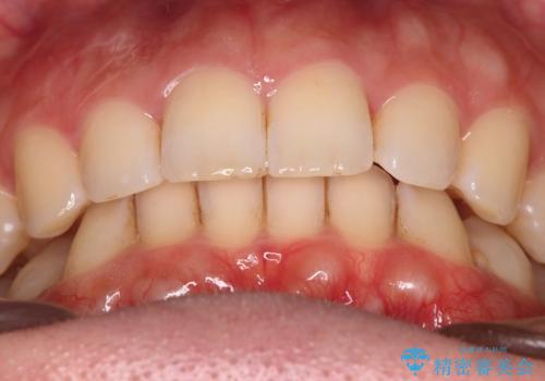 【インビザラインとワイヤー矯正】がたつきと噛み合わせを改善!の治療後