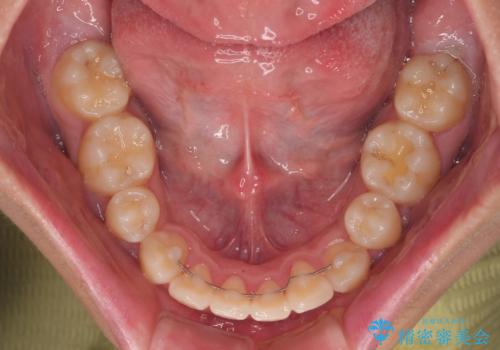 全体的なデコボコをスッキリと　ワイヤー装置での抜歯矯正の治療後