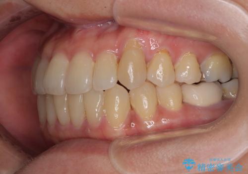 受け口と八重歯を改善 インビザライン矯正治療の治療後