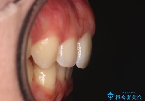 【インビザラインとワイヤー矯正】がたつきと噛み合わせを改善!の治療後