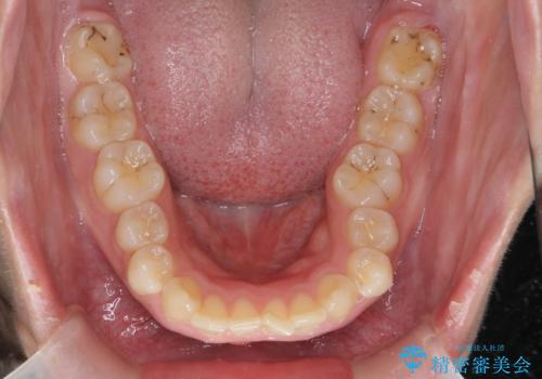深い噛み合わせ、すきっ歯の改善 ワイヤーを用いたマルチブラケット矯正の治療前