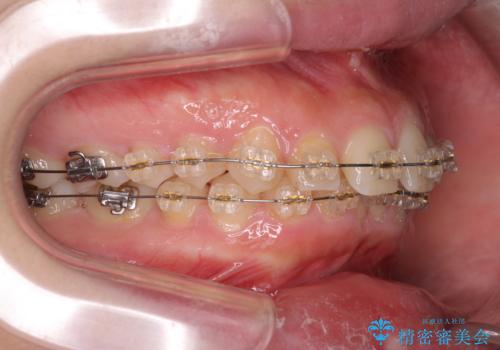 深い噛み合わせ、すきっ歯の改善 ワイヤーを用いたマルチブラケット矯正の治療前