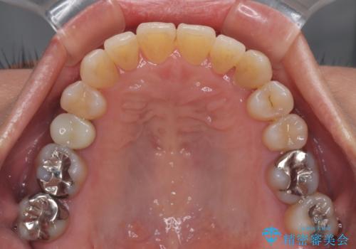 受け口と八重歯を改善 インビザライン矯正治療の治療後