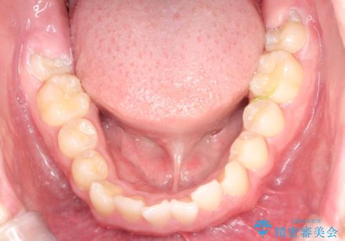 八重歯・歯並びのデコボコとディープバイトを改善した抜歯ワイヤー矯正症例の治療前
