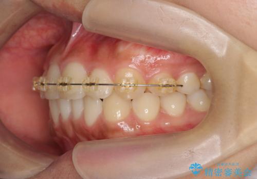 前歯のねじれ、すれ違いを改善　部分ワイヤー+マウスピース矯正の治療中
