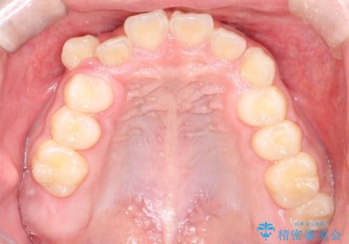 八重歯・歯並びのデコボコとディープバイトを改善した抜歯ワイヤー矯正症例の治療前