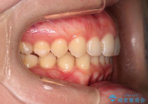 【インビザラインとワイヤー矯正】がたつきと噛み合わせを改善!の治療後