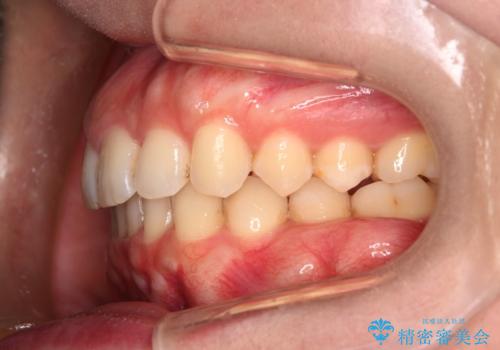 【インビザラインとワイヤー矯正】がたつきと噛み合わせを改善!の治療後