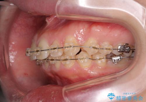深い噛み合わせ、すきっ歯の改善　ワイヤーを用いたマルチブラケット矯正の治療前