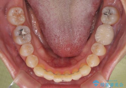 受け口と八重歯を改善　インビザライン矯正治療の治療後