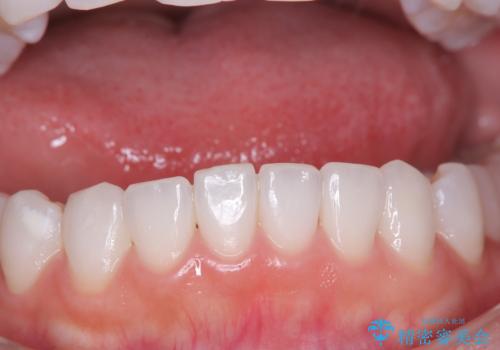 結婚式にむけてのホワイトニングの症例 治療前