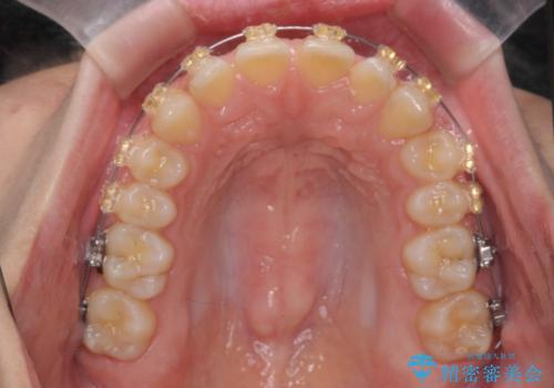 深い噛み合わせ、すきっ歯の改善　ワイヤーを用いたマルチブラケット矯正の治療前