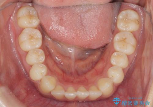 前歯のねじれ、すれ違いを改善 部分ワイヤー+マウスピース矯正の治療中
