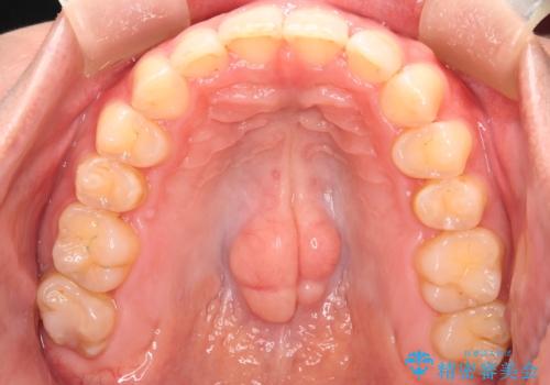 【インビザラインとワイヤー矯正】がたつきと噛み合わせを改善!の治療後