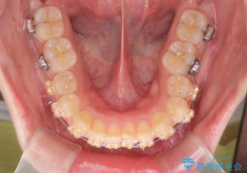 深い噛み合わせ、すきっ歯の改善　ワイヤーを用いたマルチブラケット矯正の治療前