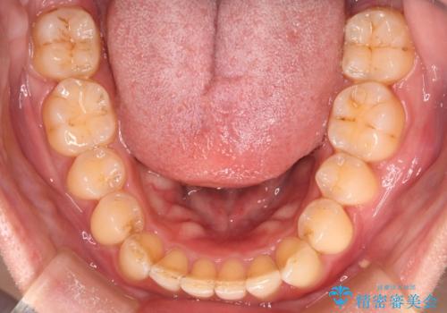 【インビザラインとワイヤー矯正】がたつきと噛み合わせを改善!の治療後