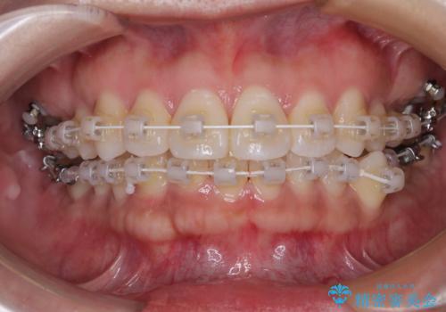 デコボコと正中のずれを改善した矯正治療の治療中