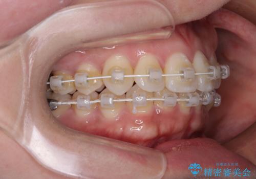 デコボコと正中のずれを改善した矯正治療の治療中