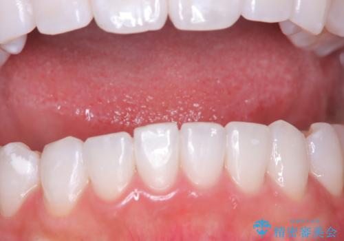 結婚式にむけてのホワイトニングの治療中