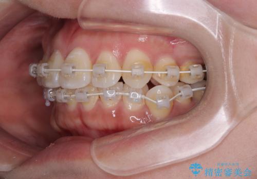 デコボコと正中のずれを改善した矯正治療の治療中