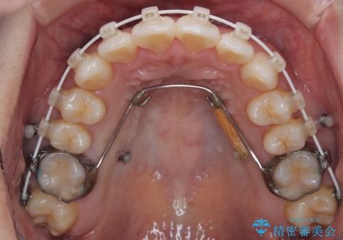 デコボコと正中のずれを改善した矯正治療の治療中
