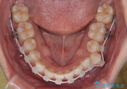 デコボコと正中のずれを改善した矯正治療の治療中