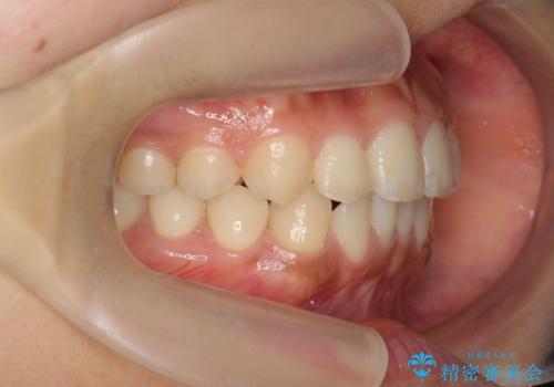 前歯のねじれ、すれ違いを改善 部分ワイヤー+マウスピース矯正の治療中