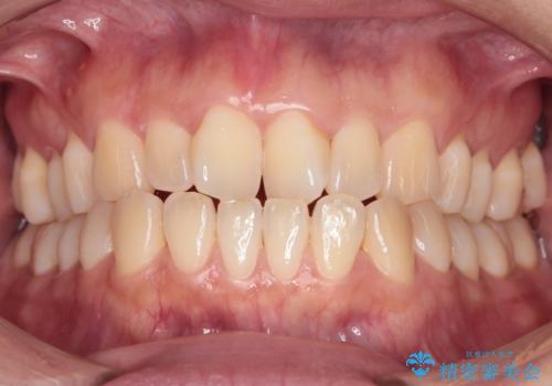 【インビザライン】前歯の捻れ気になるの症例 治療前