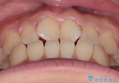 【インビザライン】前歯の捻れ気になるの治療前