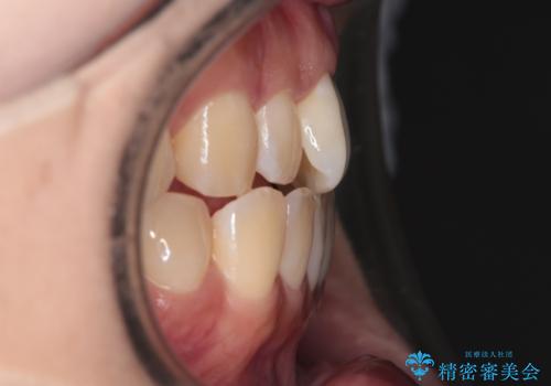 【インビザライン】前歯の捻れ気になるの治療前