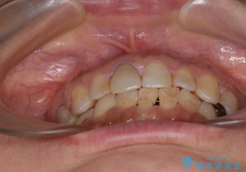 むし歯治療とインビザライン矯正治療 総合歯科治療で整った口腔内にの治療後