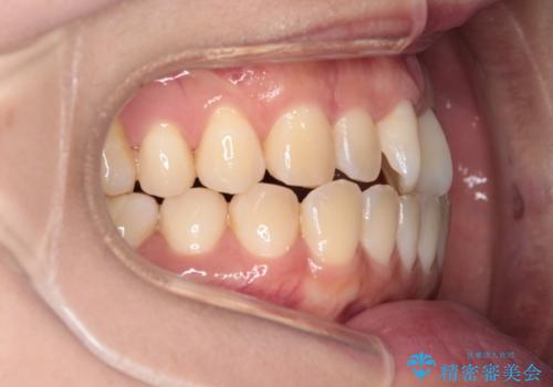 【インビザライン】前歯の捻れ気になるの治療前