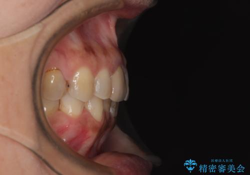 むし歯治療とインビザライン矯正治療 総合歯科治療で整った口腔内にの治療後