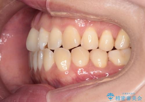 【インビザライン】前歯の捻れ気になるの治療前