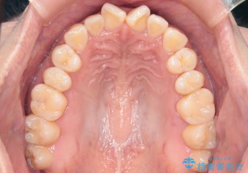 【インビザライン】前歯の捻れ気になるの治療前