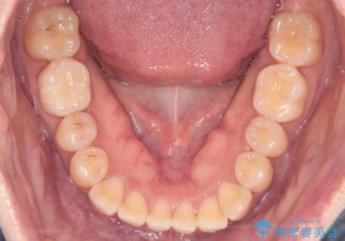 【インビザライン】前歯の捻れ気になるの治療前