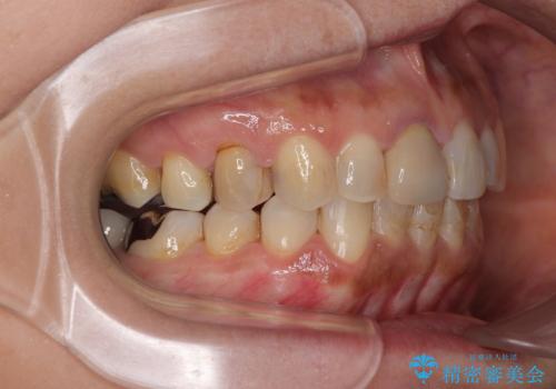 むし歯治療とインビザライン矯正治療 総合歯科治療で整った口腔内にの治療後