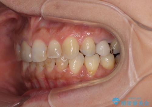 むし歯治療とインビザライン矯正治療 総合歯科治療で整った口腔内にの治療後