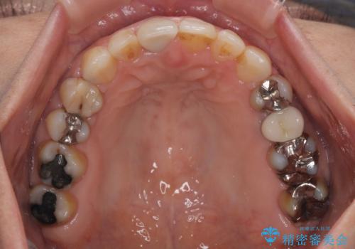 むし歯治療とインビザライン矯正治療 総合歯科治療で整った口腔内にの治療後