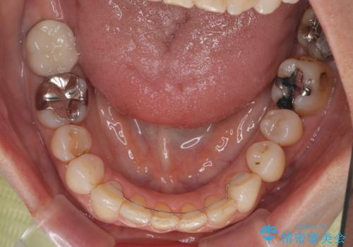 むし歯治療とインビザライン矯正治療 総合歯科治療で整った口腔内にの治療後