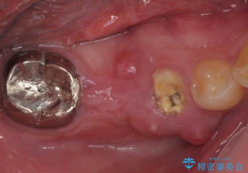 放置して膿で腫れ上がった奥歯 短期間でのインプラント治療の治療前