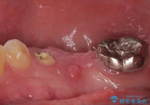 放置して膿で腫れ上がった奥歯 短期間でのインプラント治療の治療前