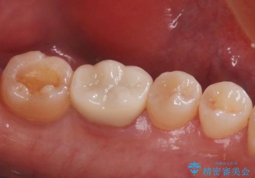 【セラミックインレー】奥歯の詰め物とれたの治療中