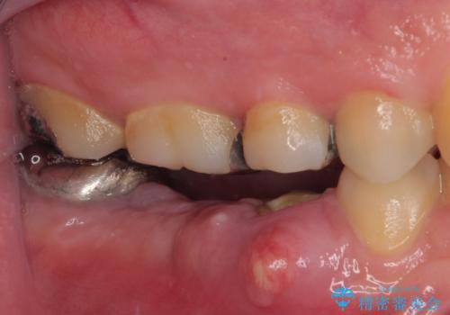 放置して膿で腫れ上がった奥歯 短期間でのインプラント治療の治療前
