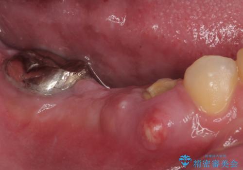 放置して膿で腫れ上がった奥歯　短期間でのインプラント治療の治療前