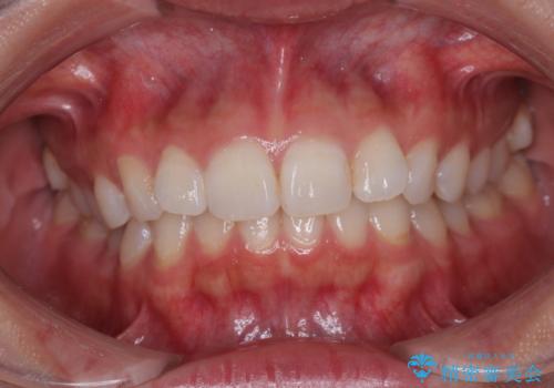 デコボコと咬み合わせを改善 インビザライン矯正治療の治療前