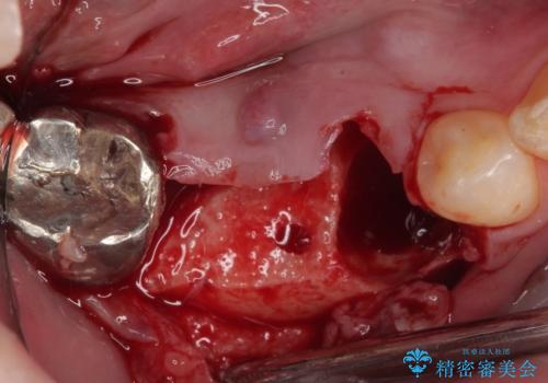 放置して膿で腫れ上がった奥歯 短期間でのインプラント治療の治療中