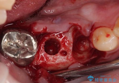 放置して膿で腫れ上がった奥歯 短期間でのインプラント治療の治療後